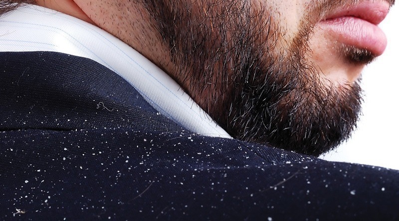 All About Male Dandruff How to Prevent, Stop and Myths |  New Old Man