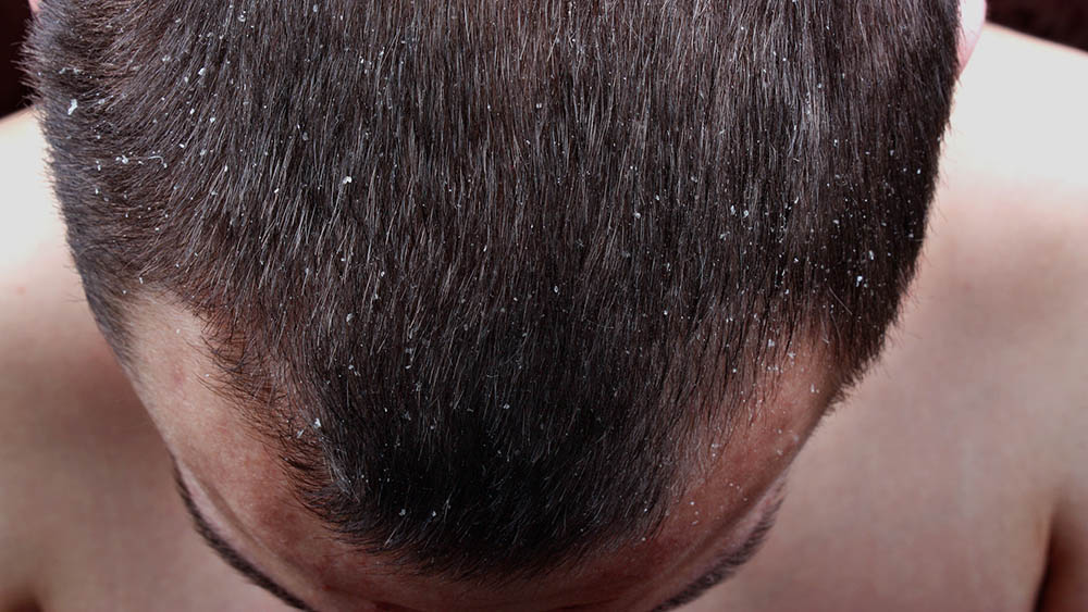 All About Male Dandruff How to Prevent, Stop and Myths |  New Old Man