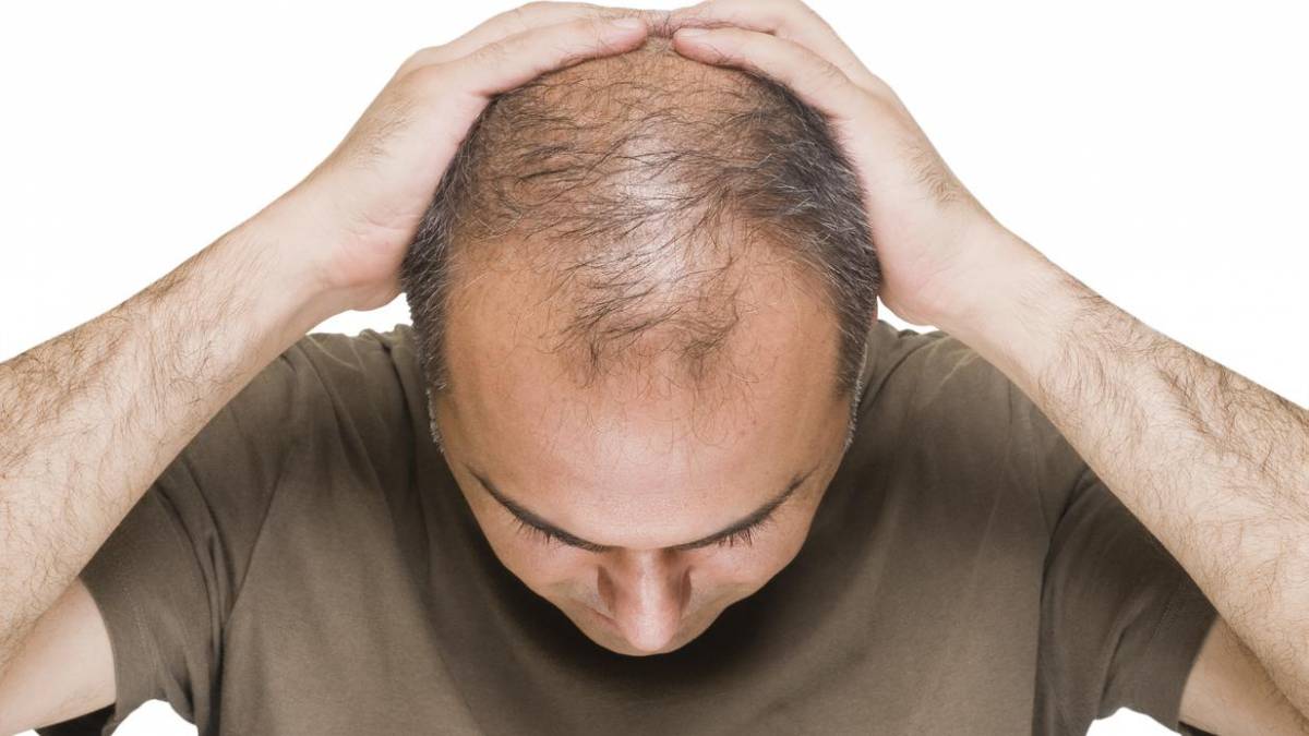 Complete Treatment for Baldness | New Old Man