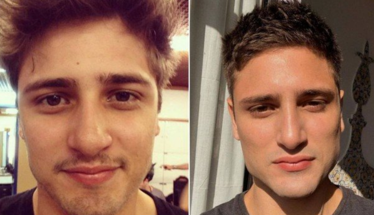 5 Antes e Depois de Harmonização Facial de Famosos