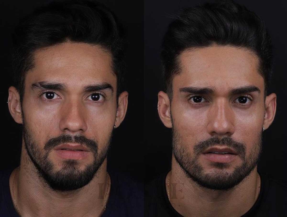 5 Antes e Depois de Harmonização Facial de Famosos