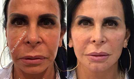 5 Antes e Depois de Harmonização Facial de Famosos