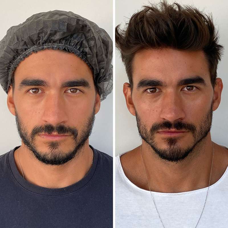 5 Antes e Depois de Harmonização Facial de Famosos | New Old Man - N.O