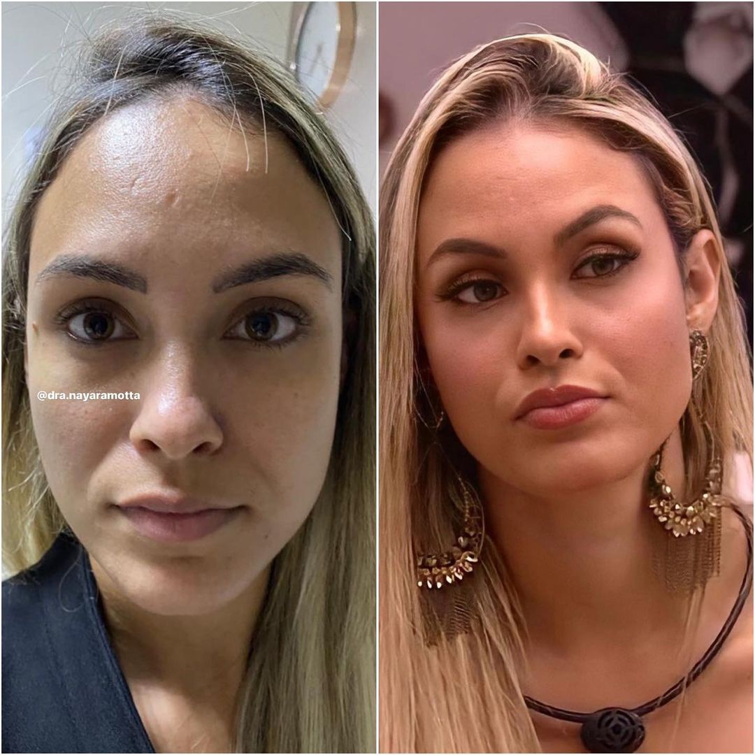 5 Antes e Depois de Harmonização Facial de Famosos