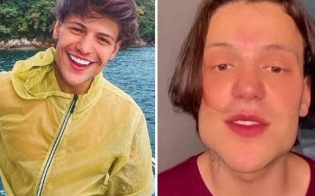 5 Antes e Depois de Harmonização Facial de Famosos