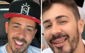 Faceta, Lente, Dente do Firmino? 5 Antes e Depois de Lente Para os